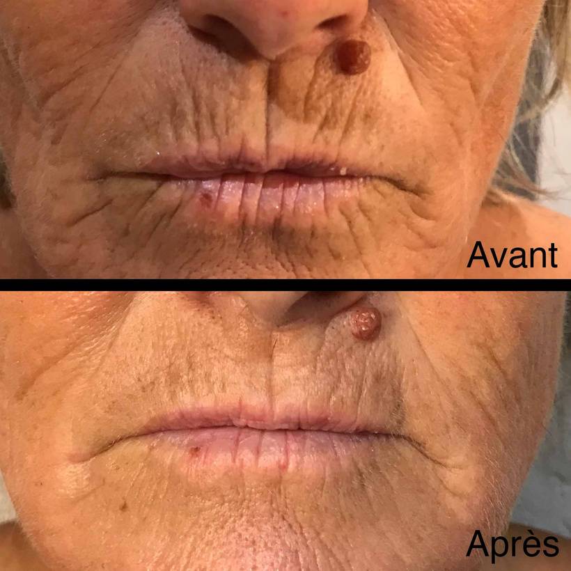 ride avant après